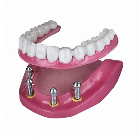 Tipos de implantes dentales: Cómo elegir la mejor opción