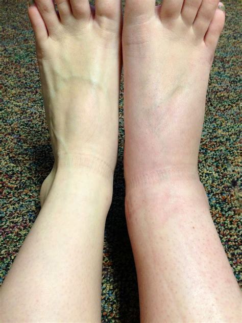 My Broken Ankle: Swollen ankle (10 Weeks Post-Op)