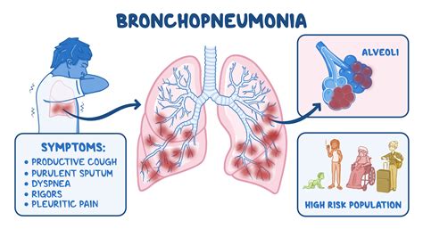 Osmosis - Bronchopneumonia: What Is It, Contagiousness, Diagnosis, Treatment, and More