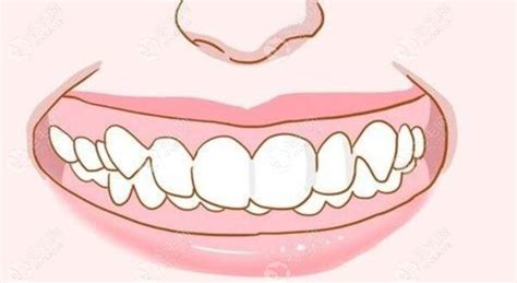 一个牙医的良心忠告种植牙(看牙科怎样才能不被坑)_金纳莱网