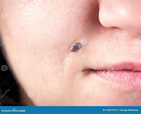 Black Mole Inside Cheek: Understanding Causes and Treatment Options