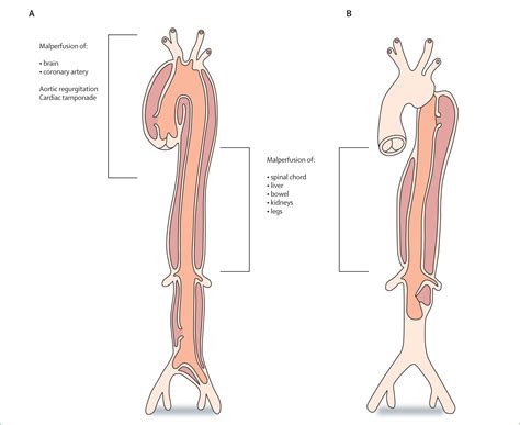 Acute aortic dissection - The Lancet