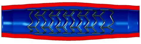 An Overview of Enhancing the Performance of Medical Implants with ...
