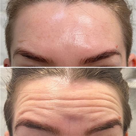 Dermal Fillers Forehead 的图像结果