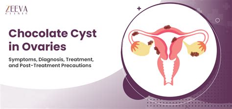 Chocolate Cyst in Ovaries- Symptoms, Diagnosis, Treatment, Care