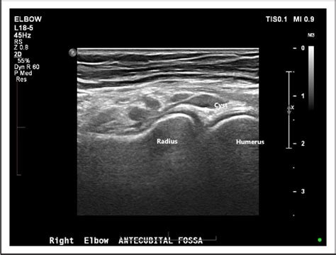 Image result for Elbow Cysts Explode