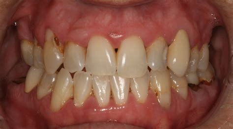 Smile Gallery - Cosmetic Dentistry Before and After Photos - Aspen ...
