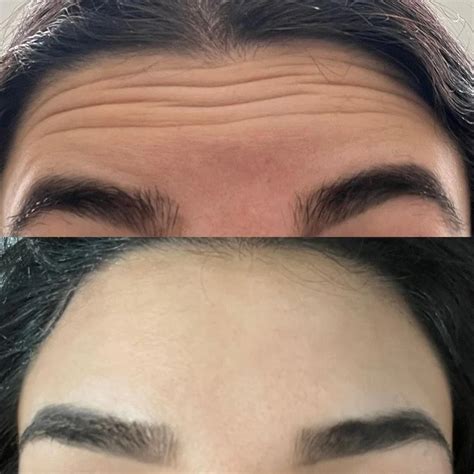 pigmentation-treatment-in-india