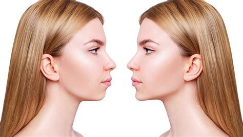 Jaw Surgery » Minneapolis Oral Surgeons » Minnesota Oral & Facial Surgery