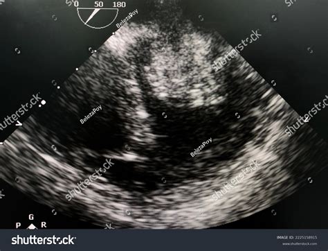 Transesophageal Echocardiogram Tee Shown Left Atrium Stock Photo 2225158915 | Shutterstock