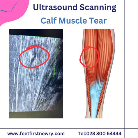 Calf Muscle Tear - Feet First Newry
