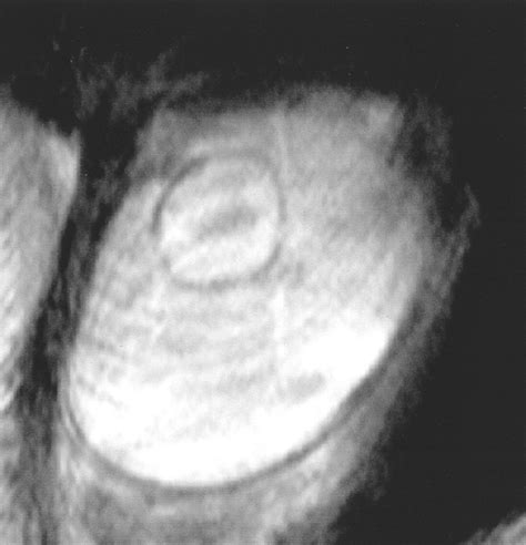 Largest Exploding Cyst 的图像结果