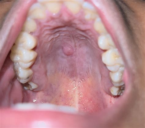 Nodule In Roof Of Mouth