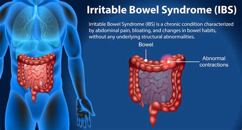 What Is The Difference Between Irritable Bowel Syndrome (IBS) and ...