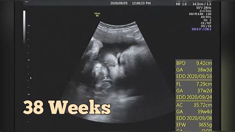 Ultrasound at 38 Weeks Pregnant | 9 Months Pregnancy Growth Scan