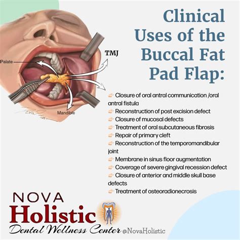 Clinical Uses of the Buccal Fat Pad Flap 🌟🦷🌸 👇🏻 🌱🧩🌿 𝘾𝙖𝙡𝙡 𝘿𝙧. 𝙎𝙝𝙚𝙧𝙞 𝙏𝙤𝙙𝙖𝙮 𝙛𝙤𝙧 𝙍𝙀𝘼… | Integrative ...