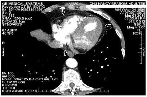 Is There an Association between Epicardial Adipose Tissue and Outcomes ...