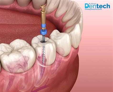 Root Canal Treatment in Powai - Dr. Karve Dentech