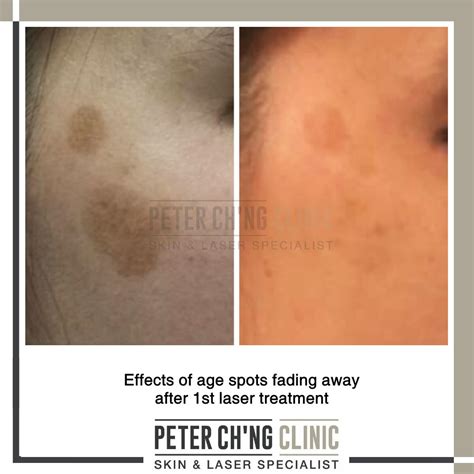 Age Spots, Freckles, or Hyperpigmentation? | Peter Ch'ng Skin Specialist - KL, Malaysia