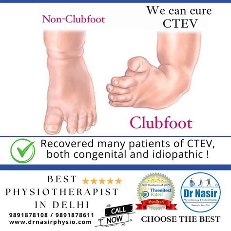 What Is A Club Foot at Mason Jaques blog
