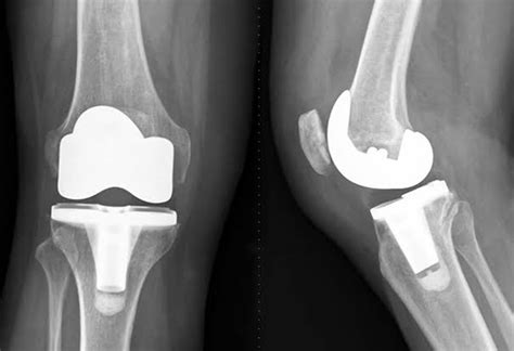 Total Hip Replacement Surgery in Dahisar | Dr Anand Walavalkar