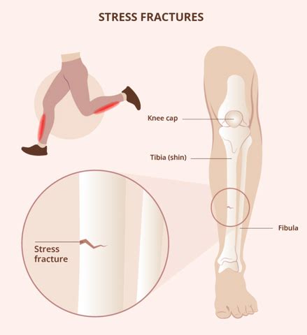 Stress Fractures in Sports: Risks, Prevention, and Recovery Strategies