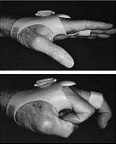 Sagittal Band Rupture (traumatic extensor tendon dislocation) : 네이버 블로그