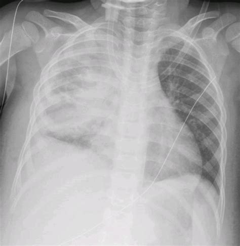 Spot Diagnosis Latest Updates | Pediatric Oncall