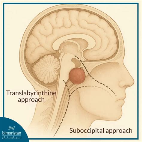 Cerebellopontine Angle Tumor