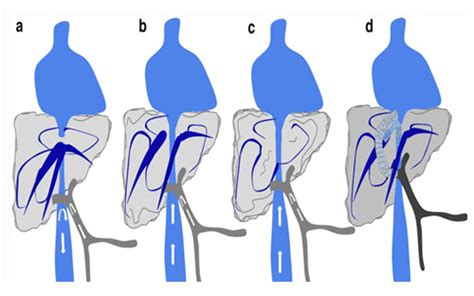 Endovascular Experts & Interventional Radiologists in South Mumbai | Dr ...