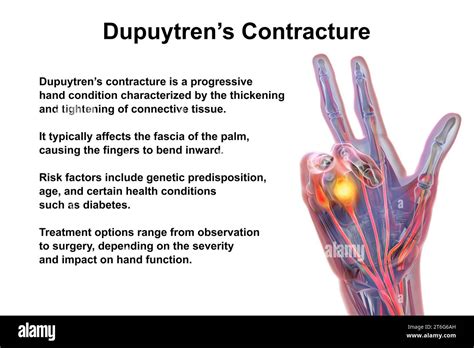 A 3D medical illustration displaying a patient's hand with Dupuytren's ...