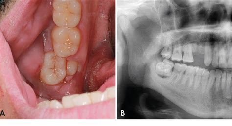 Wisdom Tooth Cyst Removal 的图像结果