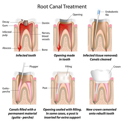 Conventional Endodontic Treatment - Endodontics | Encino CA