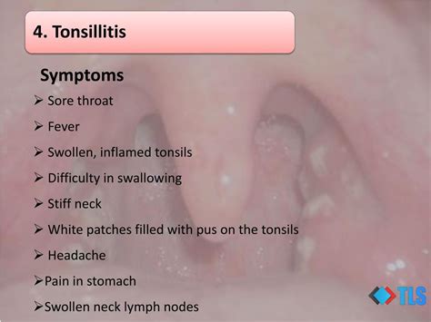 PPT - 8 Causes of White Spots On Tonsils You May Not Know PowerPoint Presentation - ID:7321615