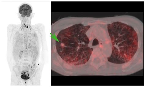 Definitions of Incidental [18F]FDG PET/CT Findings in the Literature: A ...