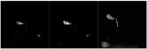 Image result for MRCP Biliary Tree