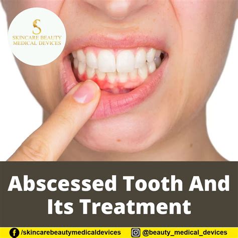Extracting Abscessed Tooth 的图像结果