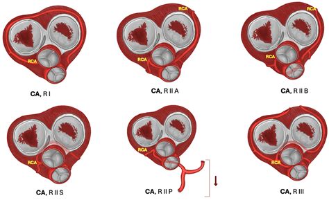 Hypoplastic and Congenital Absence of Coronary Arteries and Its ...