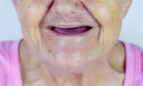 Impaired Chewing Linked to Higher Mortality: Diet and Oral Health ...