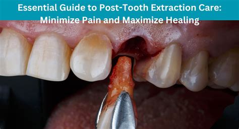Post Tooth Extraction Healing 的图像结果