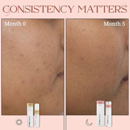 AHA BHA PHA Face Serum | Exfoliating Chemical Peel – SkinInspired
