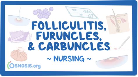 Image result for Carbuncle Extraction Doctor