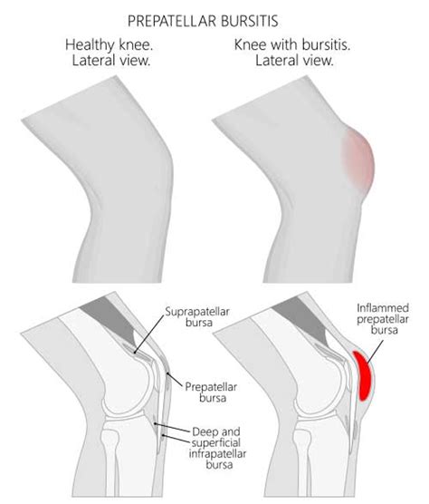 Knee Bursitis: Causes, Symptoms, and Pain Relief
