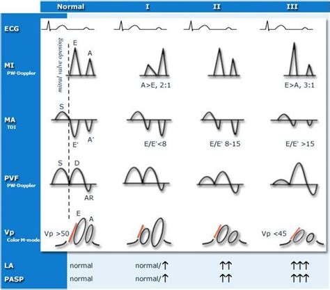 Image result for Moderate Diastolic Dysfunction