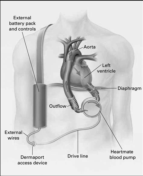 What is Congestive Heart Failure - Stages, Causes, Signs, Symptoms