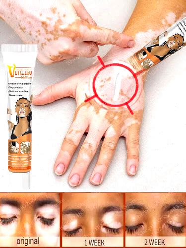 Eelhoe Vitiligo & Ringworm Ointment for Spot Removal, India | Ubuy