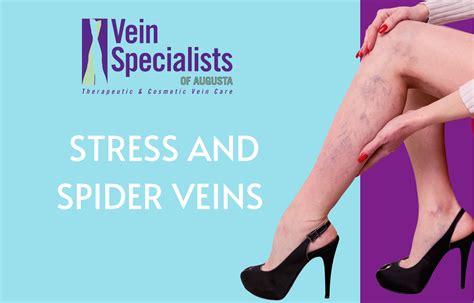 Spider Veins Legs