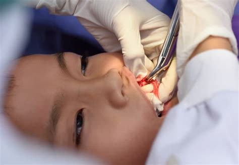 Image result for Basic Tooth Extraction