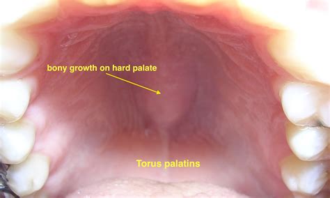 Herpes simplex orofacial infection - wikidoc