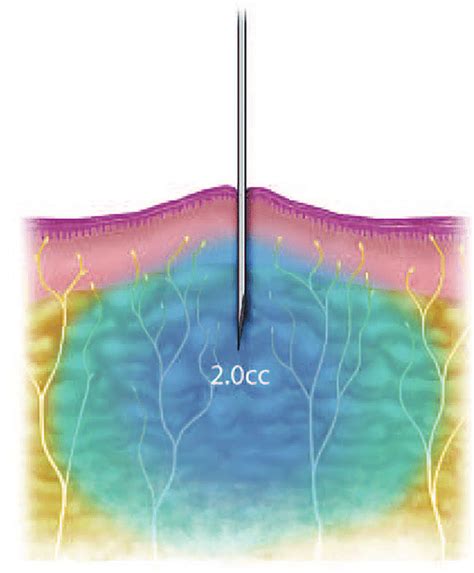 Administration of Local Anesthesia 的图像结果